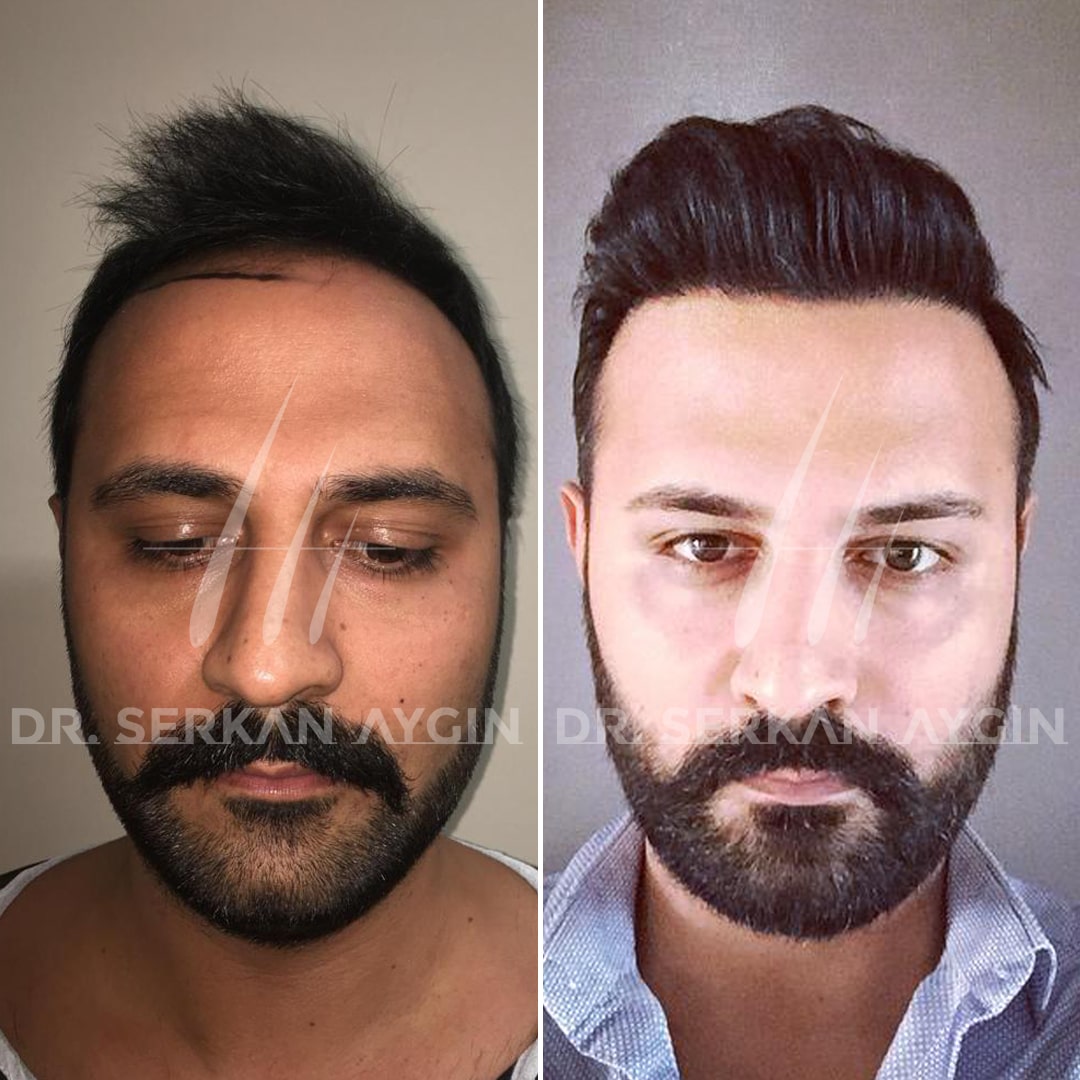 DHI Hair Transplant: 3900-3950 Grafts - Dr. Serkan Aygin Clinic