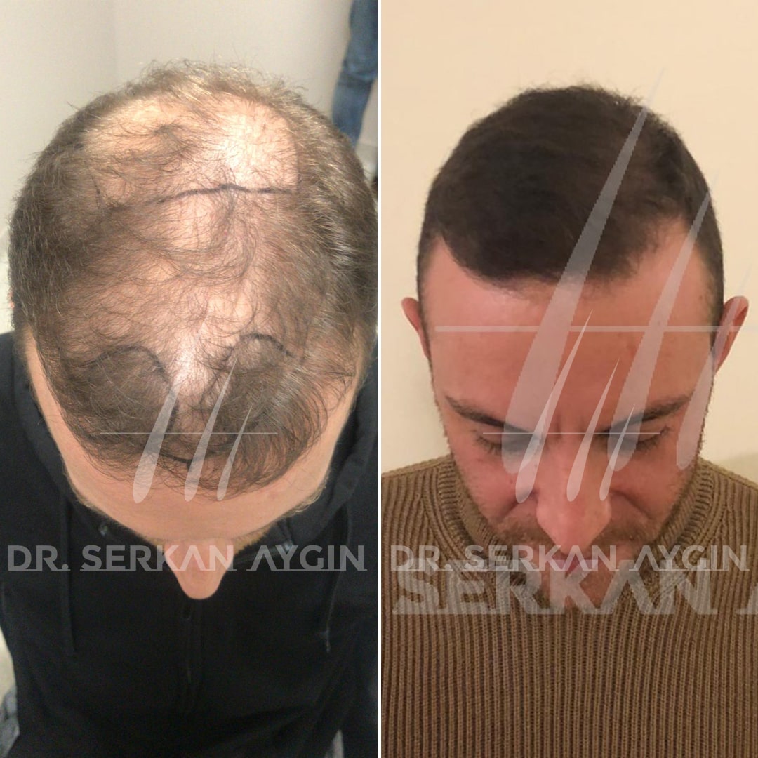 DHI Hair Transplant: 3050-3100 Grafts - Dr. Serkan Aygin Clinic