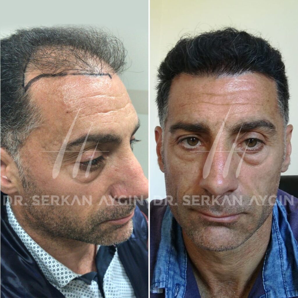 Hair Transplant Turkey Before And After