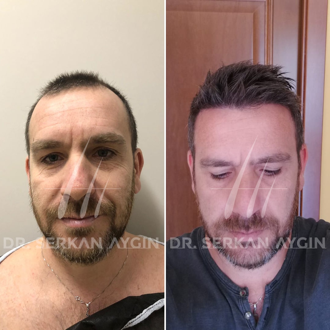 DHI Hair Transplant: 3250-3300 Grafts - Dr. Serkan Aygin Clinic