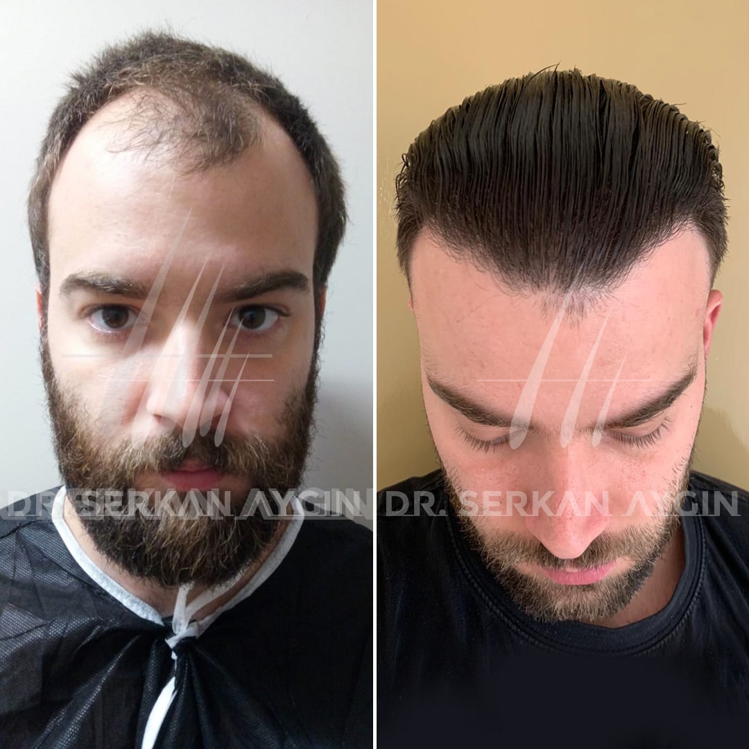 DHI Hair Transplant: 4450-4500 Grafts - Dr. Serkan Aygin Clinic