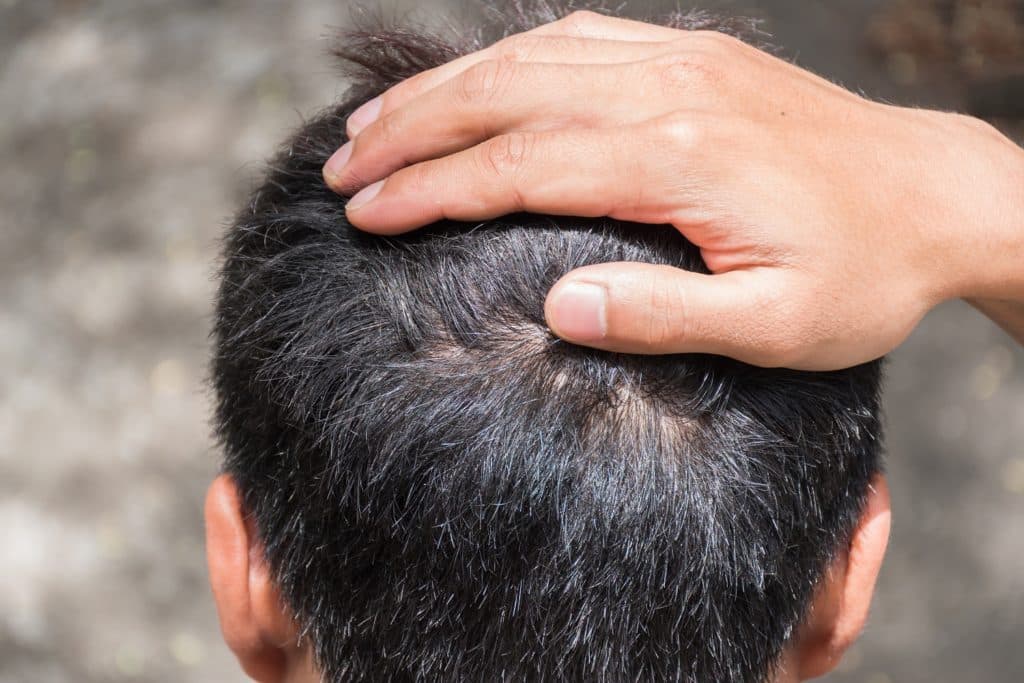 how to get rid of itching after hair transplant