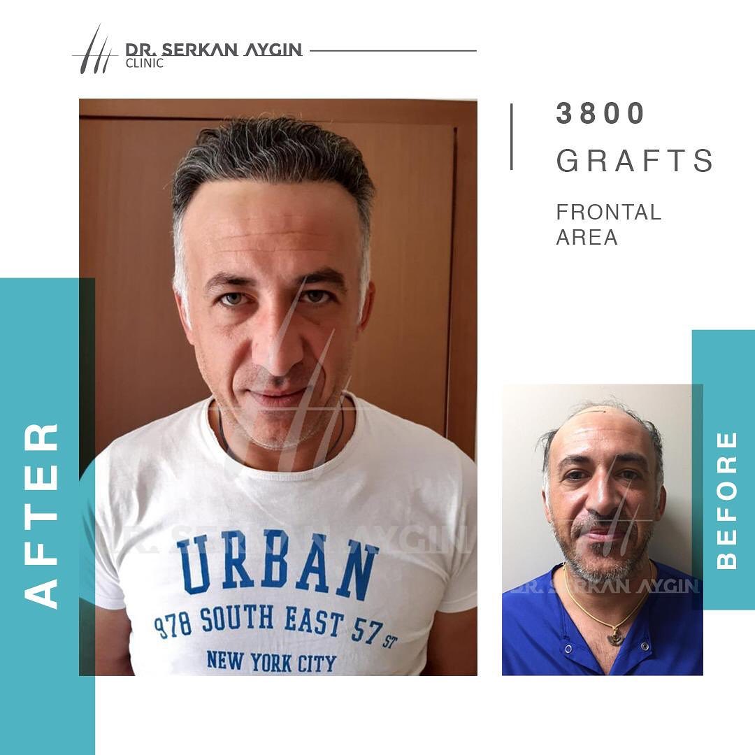 Hair Transplant Pictures: Before & After - Dr. Serkan Aygin Clinic