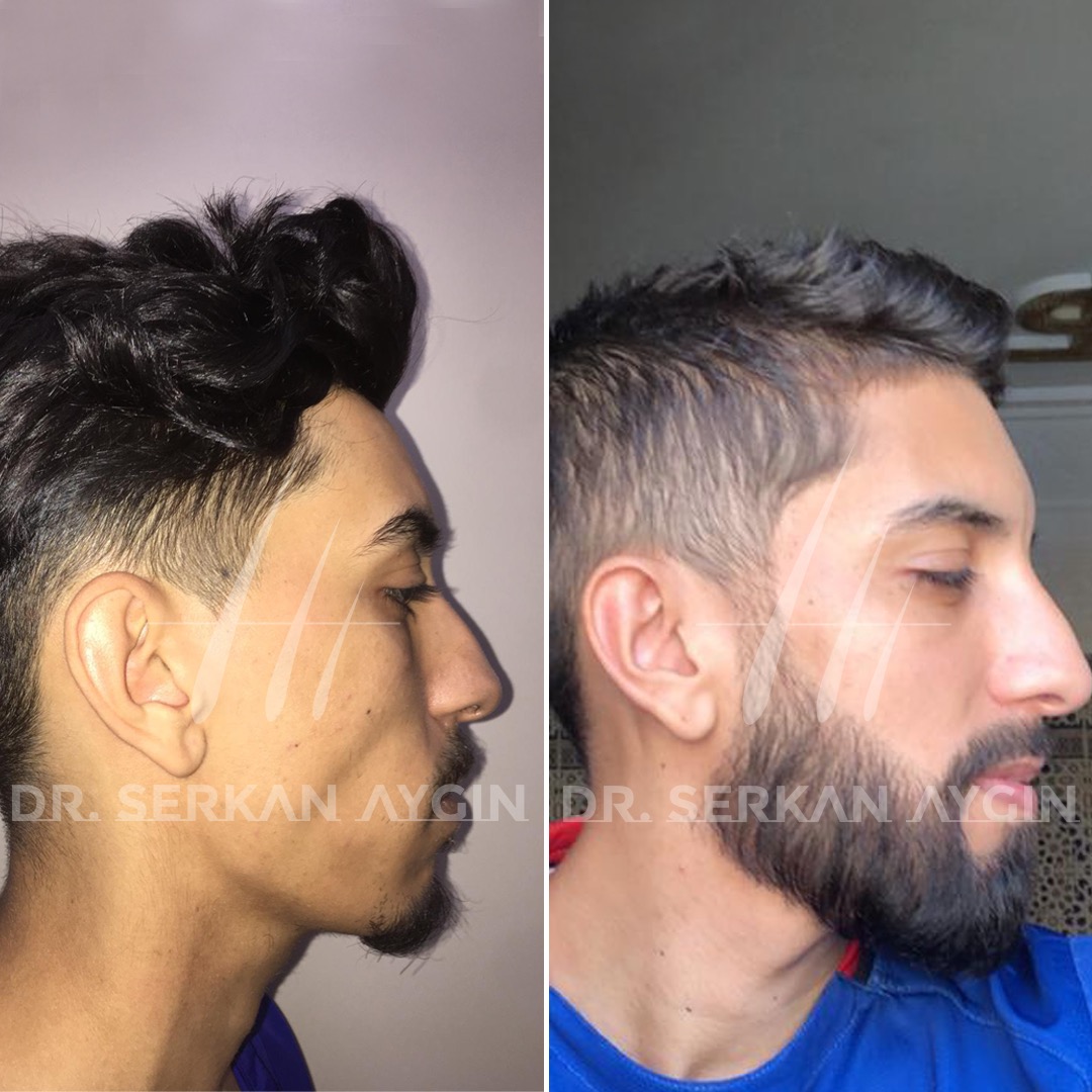 Beard Transplant Before and After - Dr. Serkan Aygin Clinic