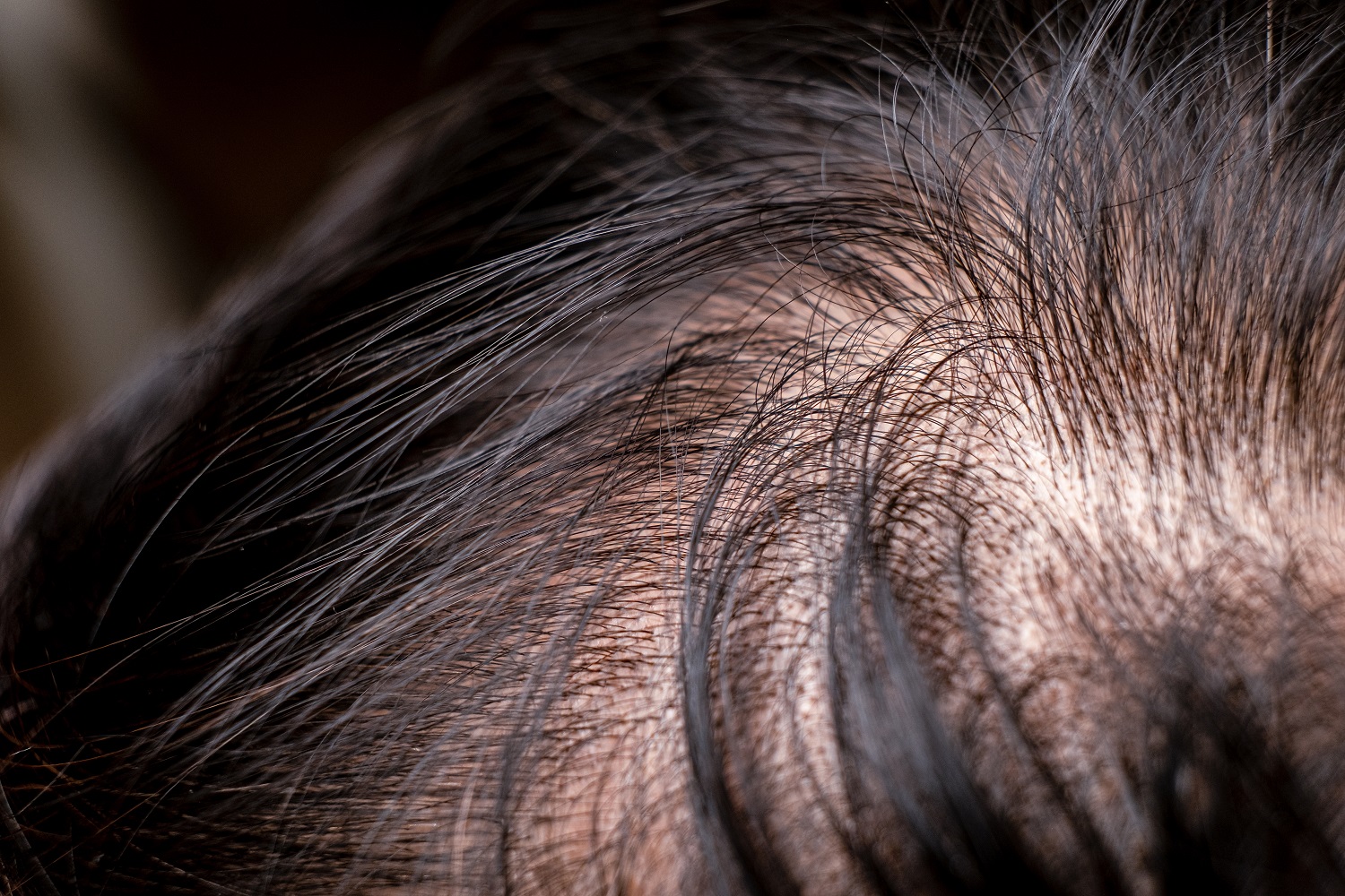 What is Diffuse Hair Loss? - Dr. Serkan Aygin Clinic