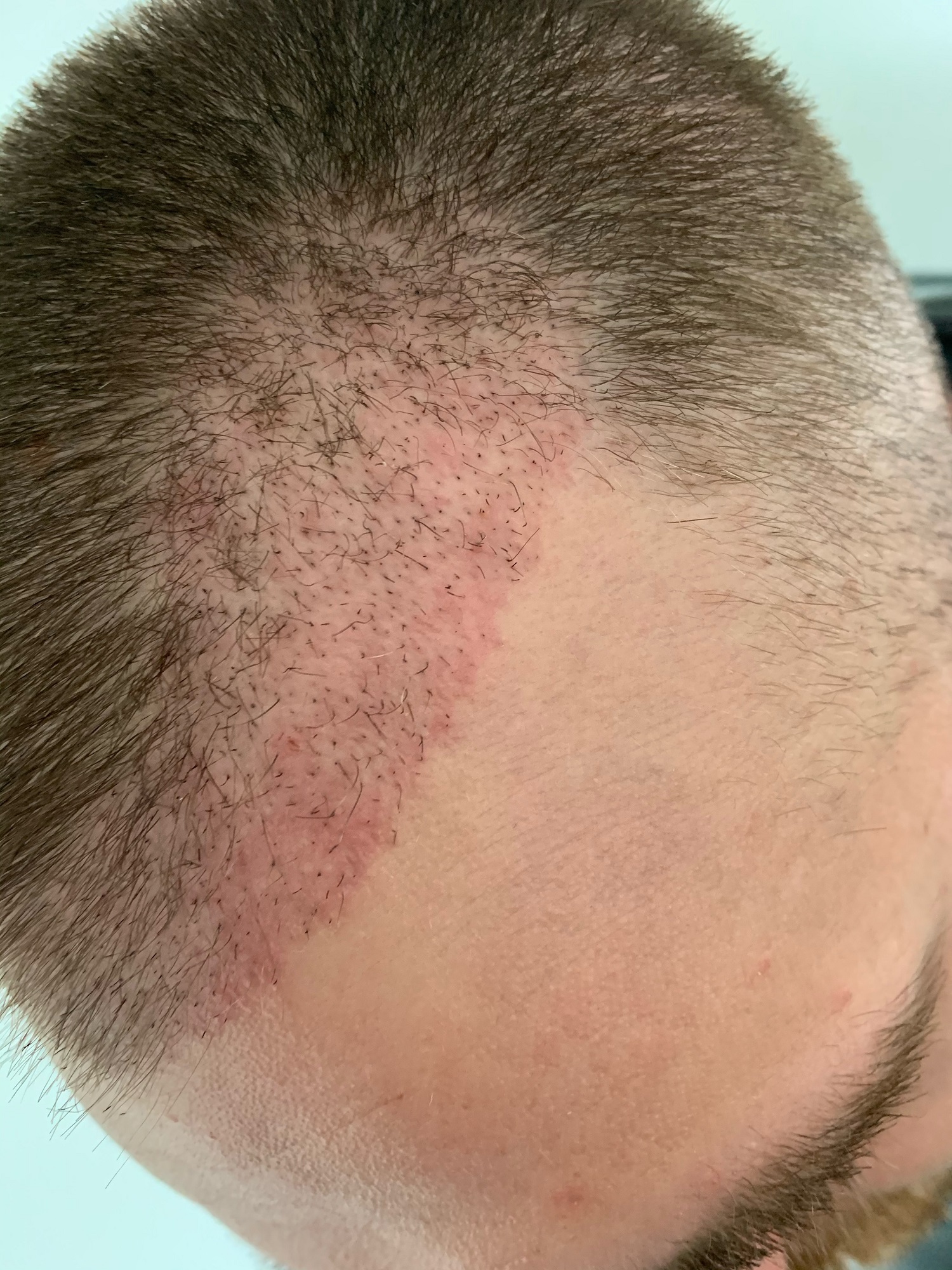 Hair Transplant: When Does Redness Go Away?