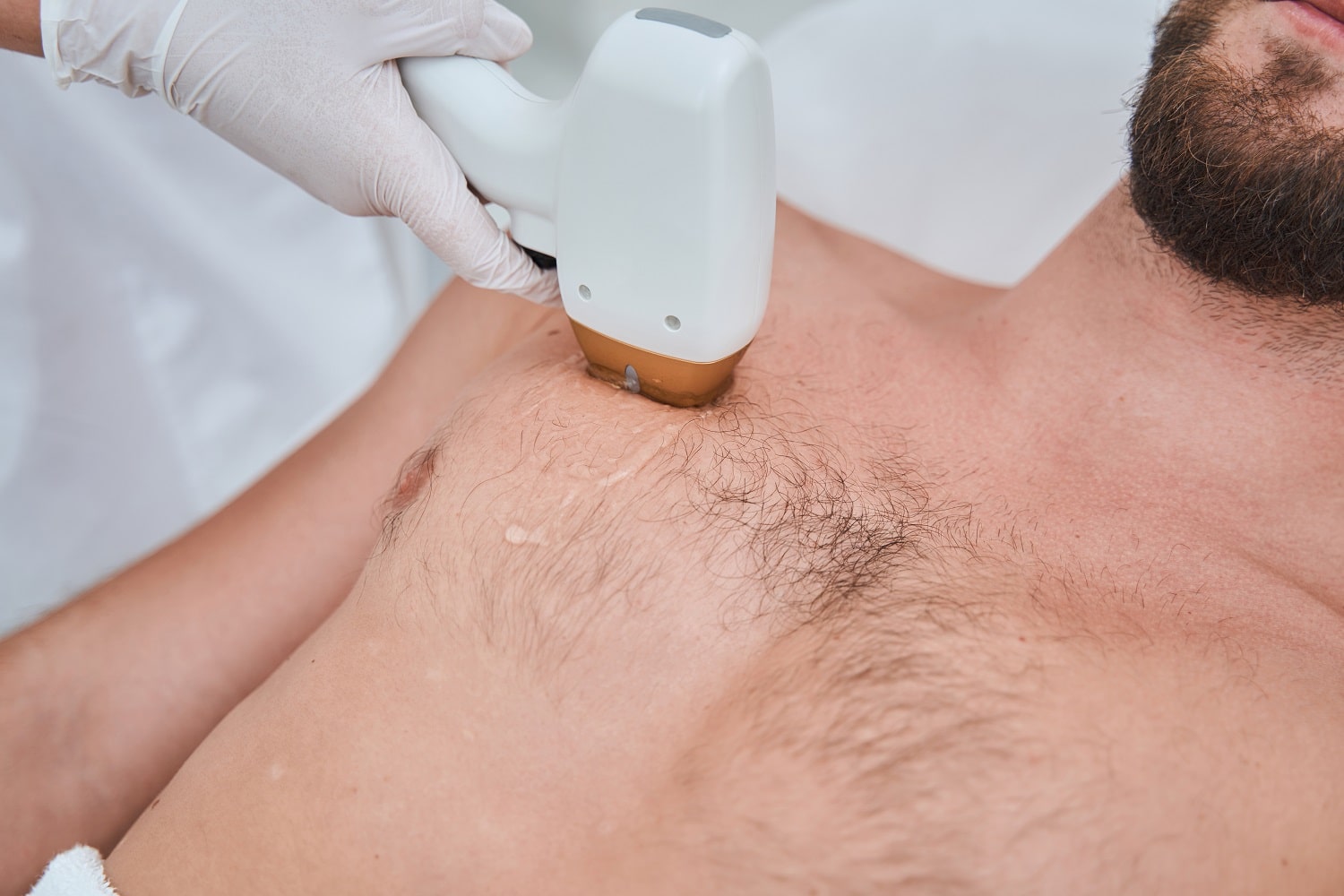 Can I Use Body Hair in a Hair Transplant?